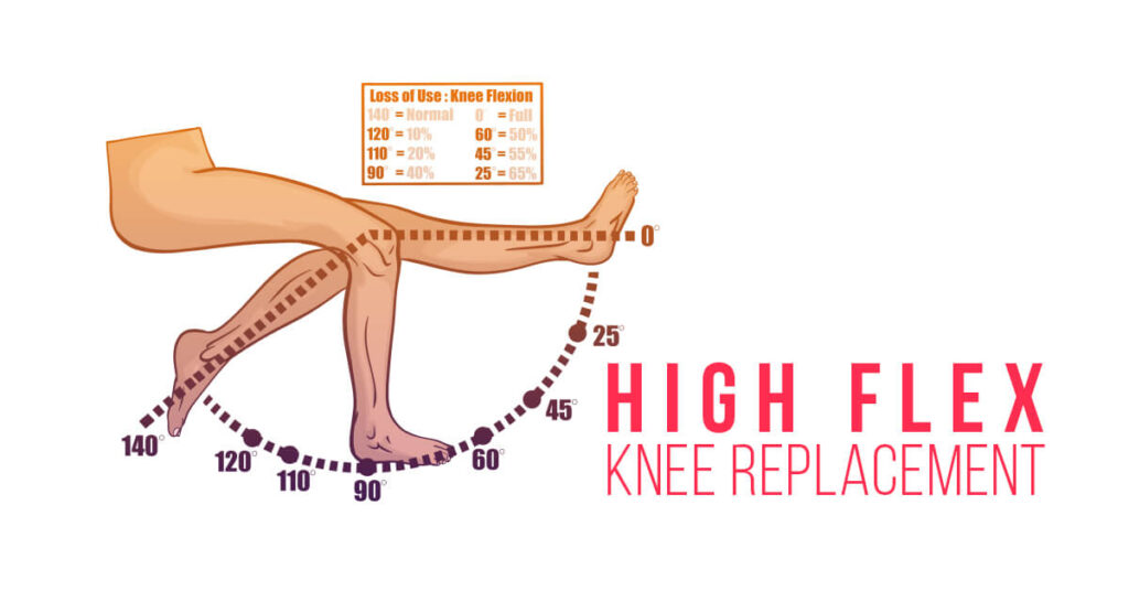 Advantages of High Flexion Knee Replacement